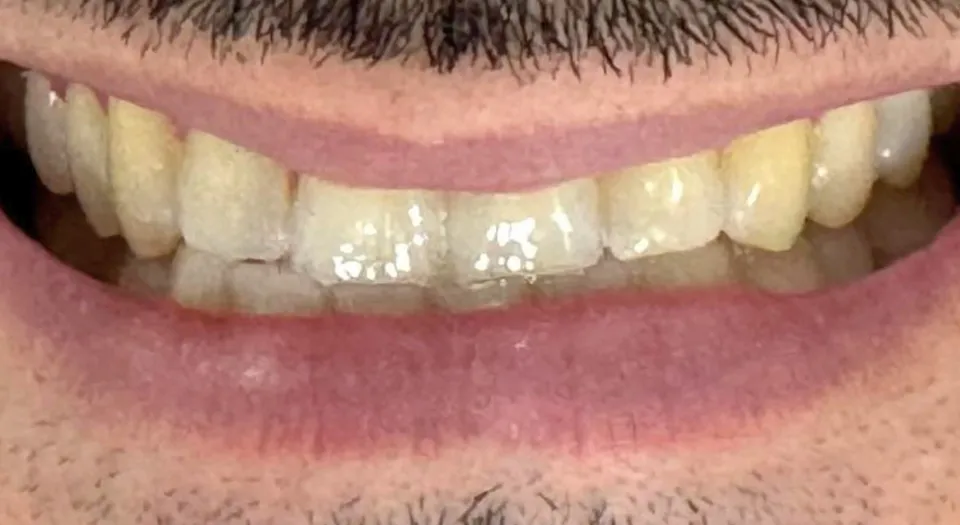 Antes do tratamento — Clareamento dentário. Valorização da estética do sorriso.