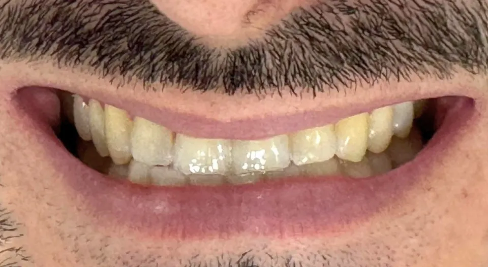 Antes do tratamento — Coroa de porcelana. Restauração de dente comprometido.
