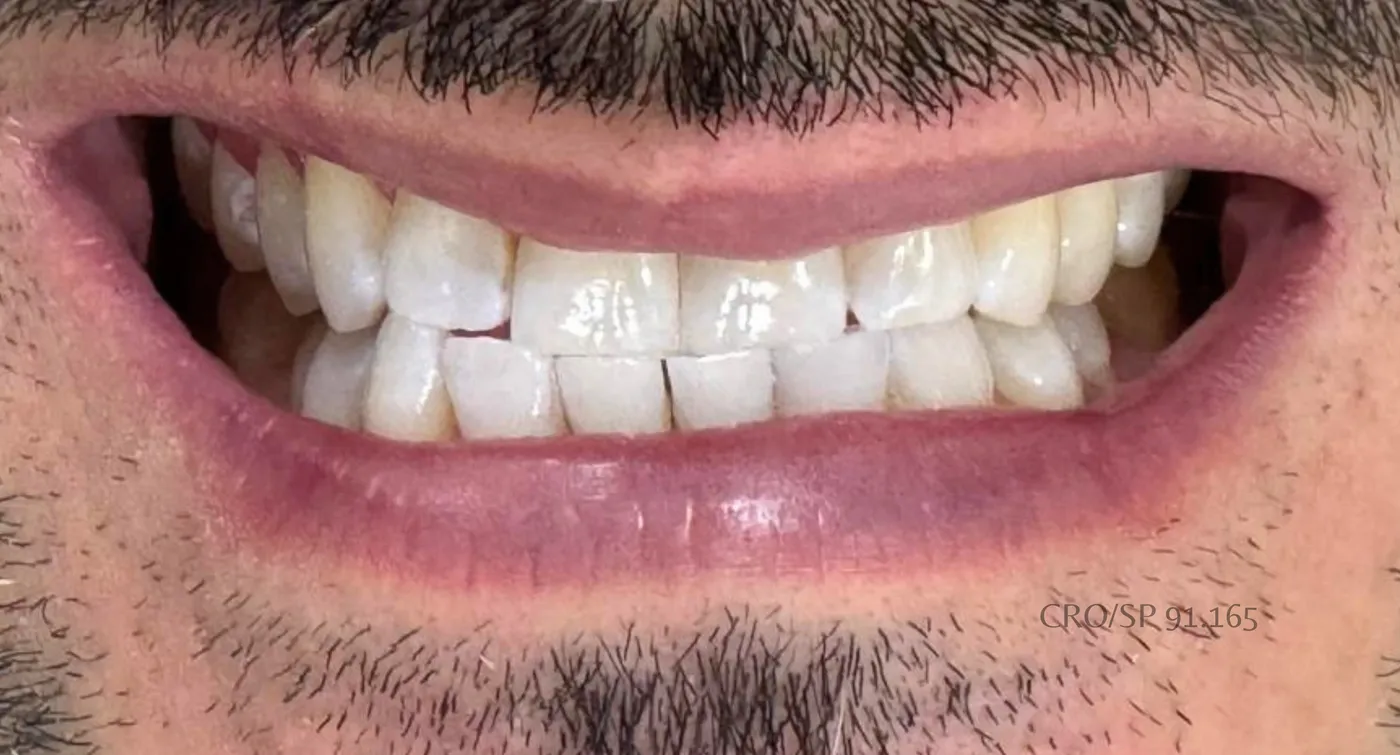 Depois do tratamento — Coroa de porcelana. Restauração de dente comprometido.
