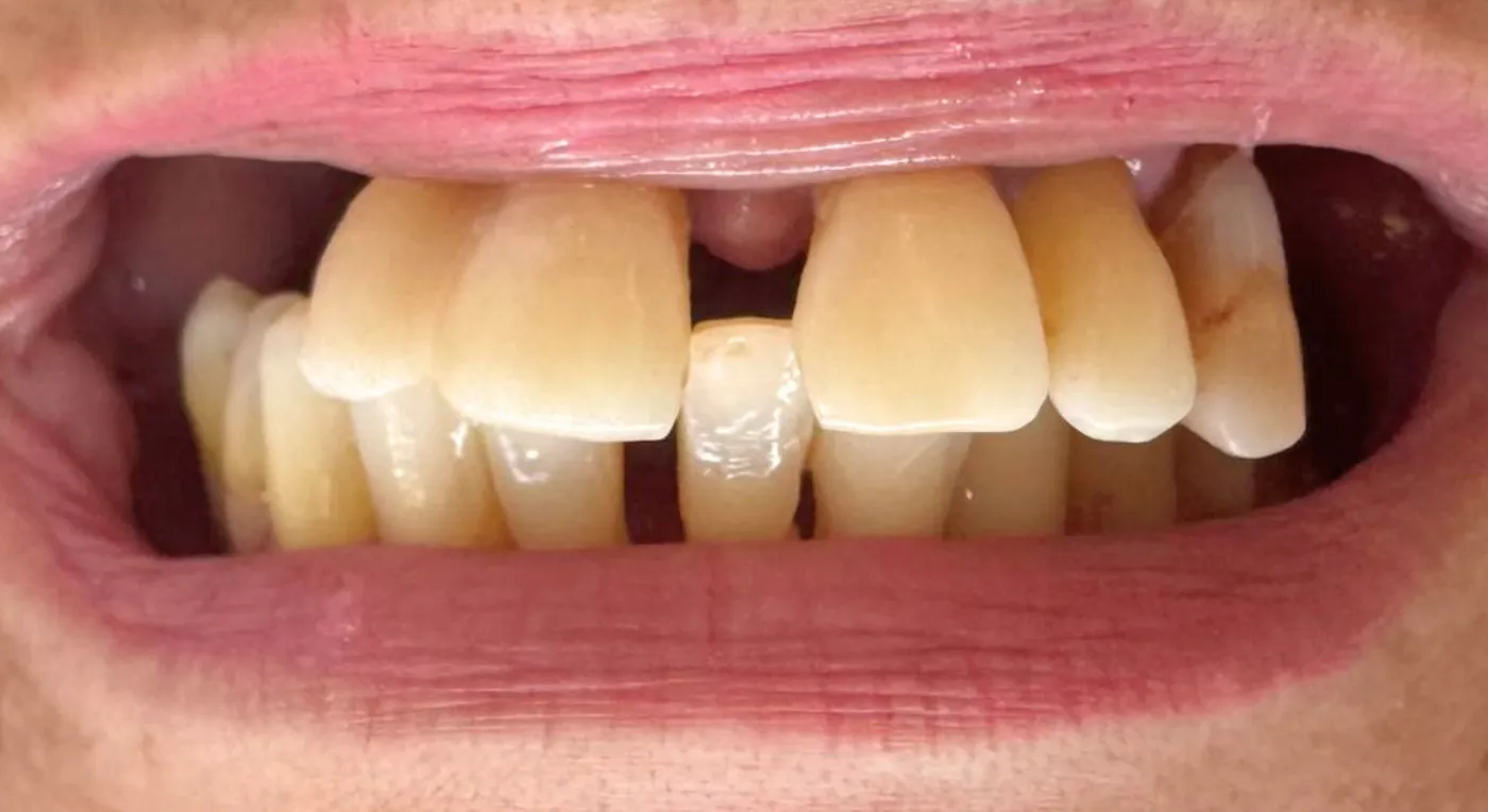Antes do tratamento — Protocolo — prótese fixa sobre implantes
