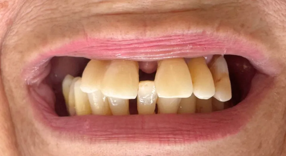 Antes do tratamento — Protocolo — prótese fixa sobre implantes. Reabilitação de arcada completa.
